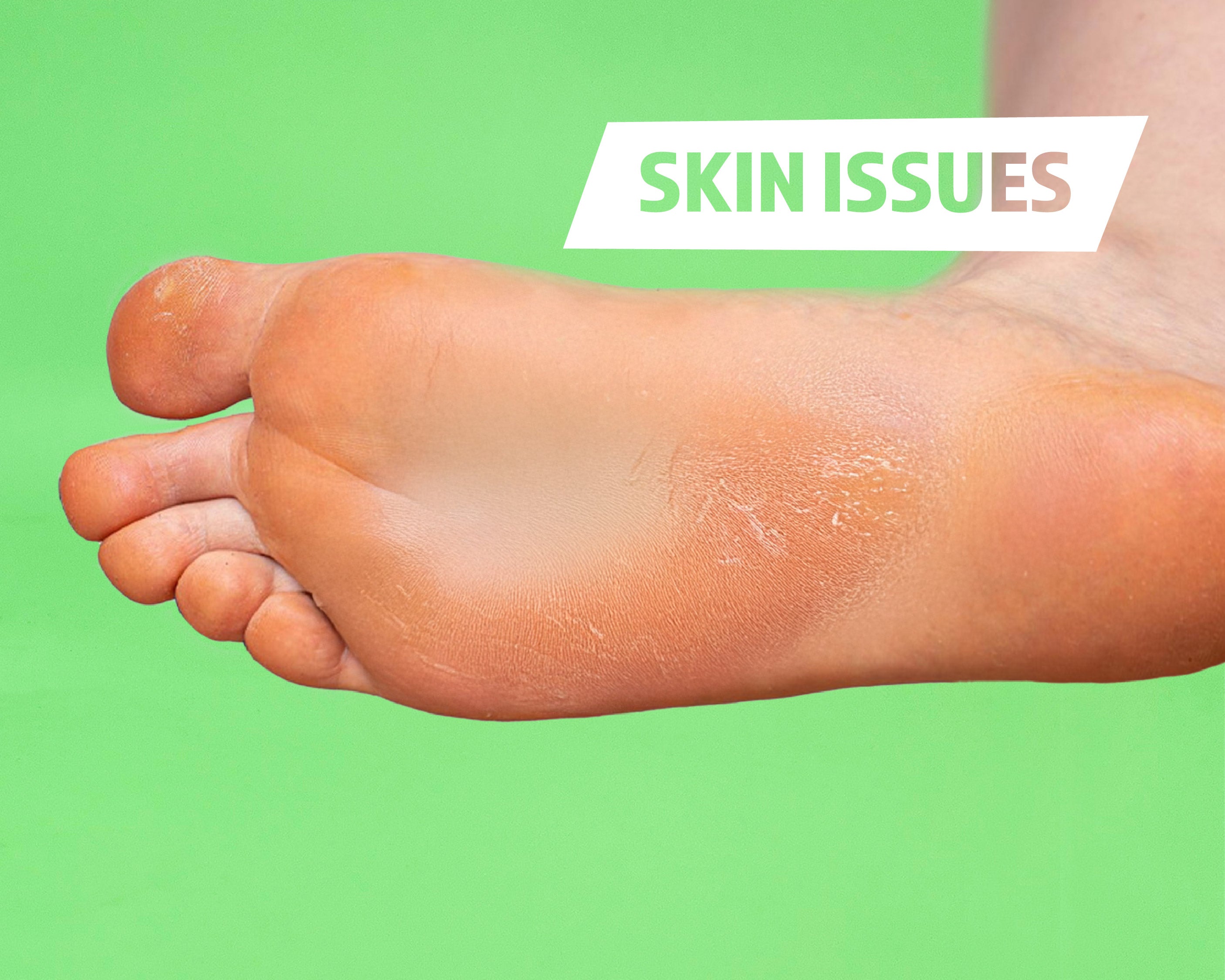 Foot with visible skin issue on a green background with 'SKIN ISSUES' text.